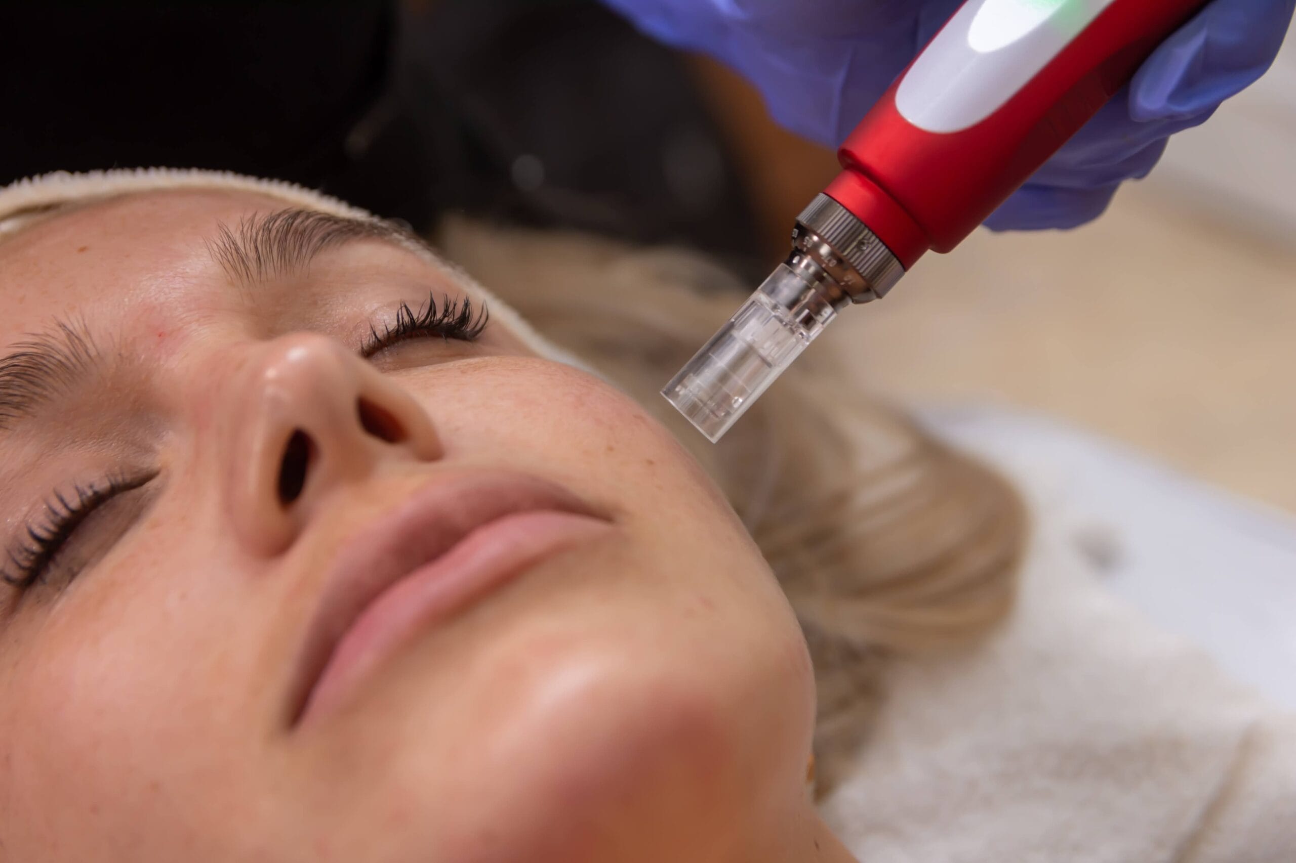 Es un procedimiento no doloroso que utiliza un dispositivo con microagujas para mejorar la piel mediante la aplicación de principios activos.</p>
<p>Beneficios: Mejora arrugas, líneas finas, cicatrices, flacidez, estrías, poros dilatados y el aspecto general de la piel.</p>
<p>Sesiones cada 7 o 15 días, dependiendo del caso.</p>
<p>No requiere tiempo de recuperación.</p>
<p>