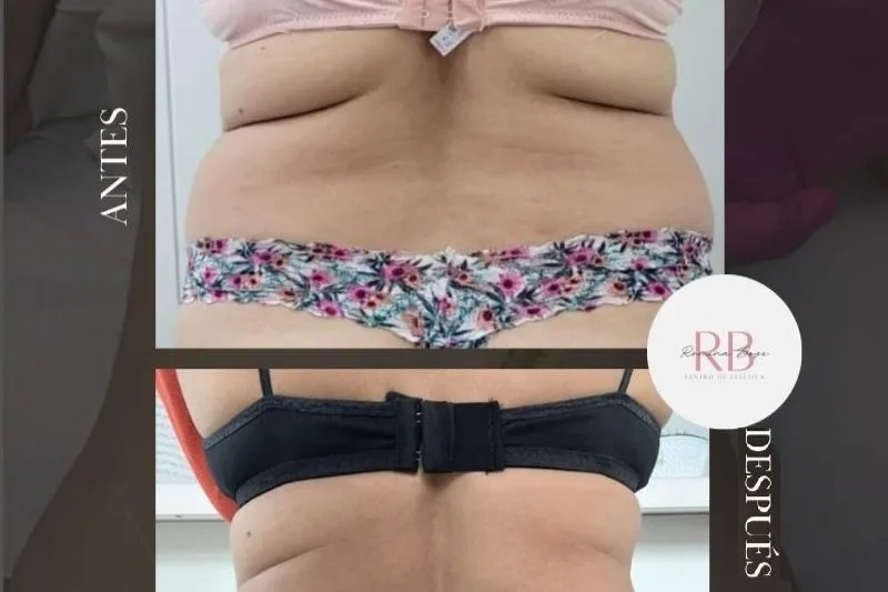 Lipólisis enzimática