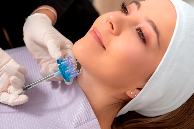 Lipo de papada sin cirugía