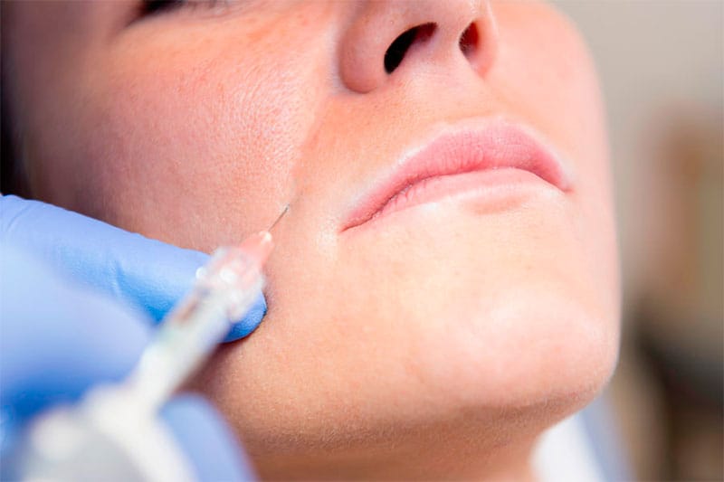 rellenos de ácido hialurónico