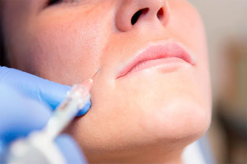 Rellenos de ácido hialurónico